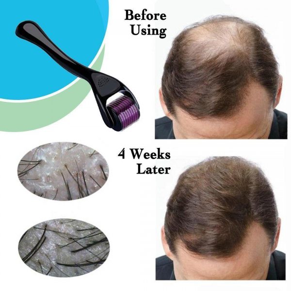 Hair Growth Roller - iamlazy.store