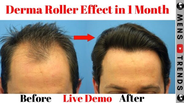 Hair Growth Roller - iamlazy.store