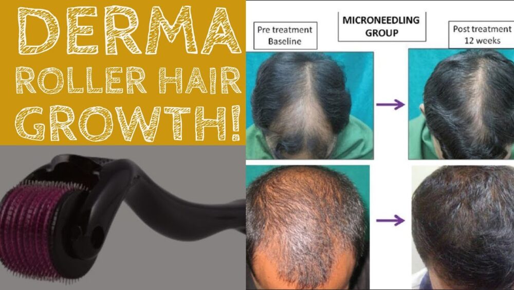 Hair Growth Roller - iamlazy.store